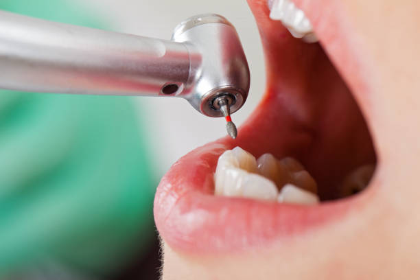 Best Emergency Tooth Extraction in North El Monte, CA